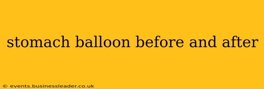 stomach balloon before and after