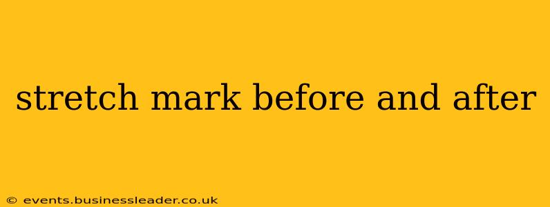 stretch mark before and after