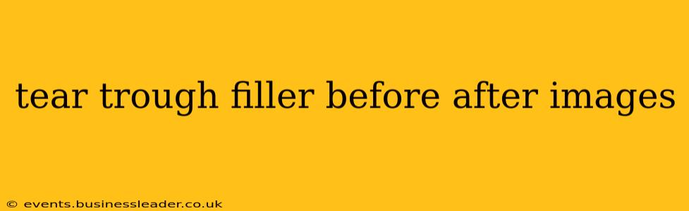 tear trough filler before after images