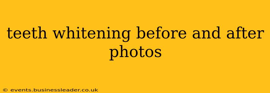 teeth whitening before and after photos