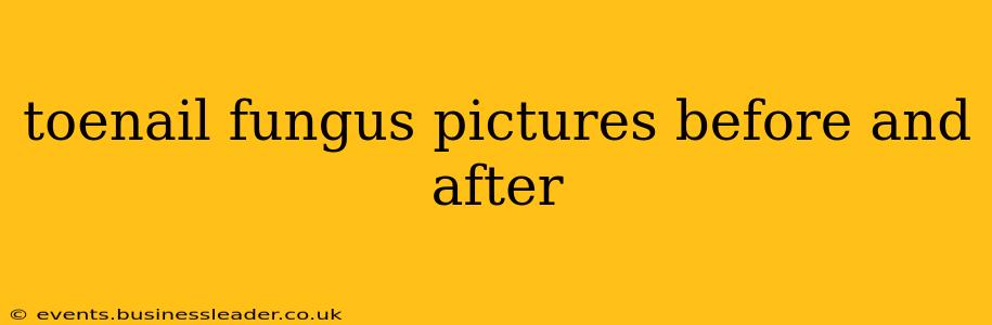 toenail fungus pictures before and after