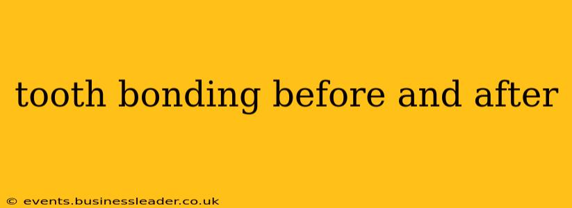 tooth bonding before and after