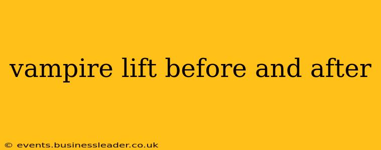 vampire lift before and after