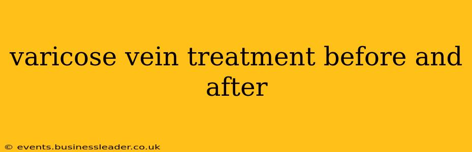 varicose vein treatment before and after