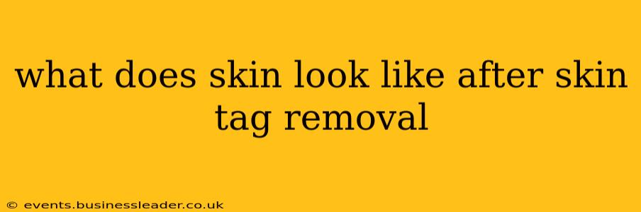 what does skin look like after skin tag removal