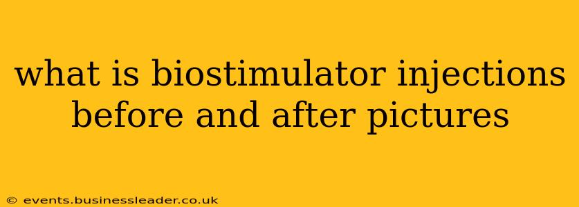what is biostimulator injections before and after pictures